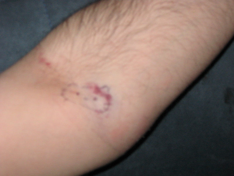 hello-kitty-bruise-2 Hello Kitty bruise