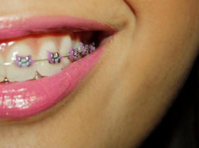 Hello Kitty pink braces Hello Kitty pink braces