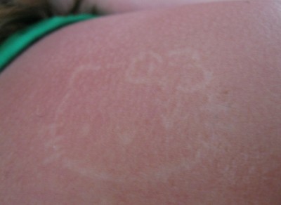 hello kitty sunburn